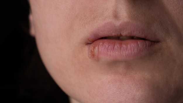 Рекомендации по профилактике трещин в уголках губ