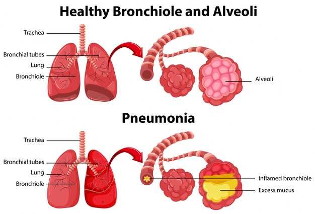 Различия между пневмонией и бронхопневмонией
