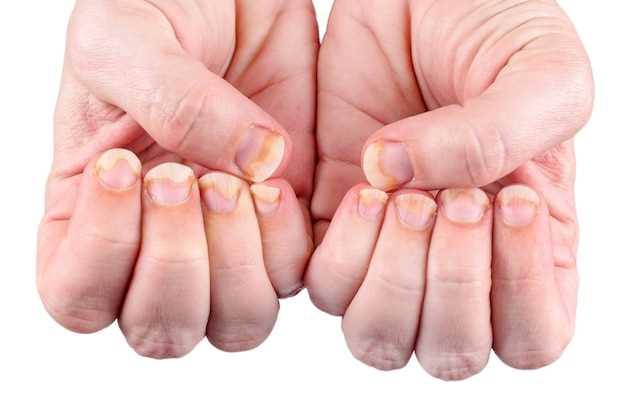 Причины появления волнистых ногтей